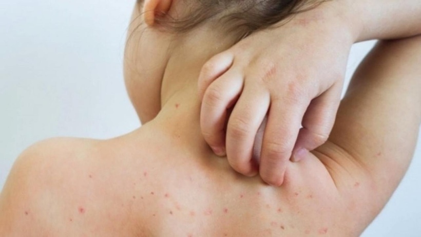 Một ca rubella vừa phát hiện: Bố mẹ chủ quan, trẻ lãnh hậu quả 1 Một ca rubella vừa phát hiện: Bố mẹ chủ quan, trẻ lãnh hậu quả mot ca rubella vua phat hien bo me chu quan tre lanh hau qua