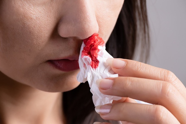 Bác sĩ cảnh báo: Cẩn trọng với những vết bầm lạ trên da! 1 Bác sĩ cảnh báo: Cẩn trọng với những vết bầm lạ trên da!