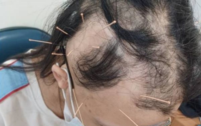 Đột nhiên tóc rụng từng mảng tới "hói trắng cả đầu", nữ sinh bàng hoàng khi nghe bác sĩ tiết lộ nguyên nhân 1 Đột nhiên tóc rụng từng mảng tới "hói trắng cả đầu", nữ sinh bàng hoàng khi nghe bác sĩ tiết lộ nguyên nhân