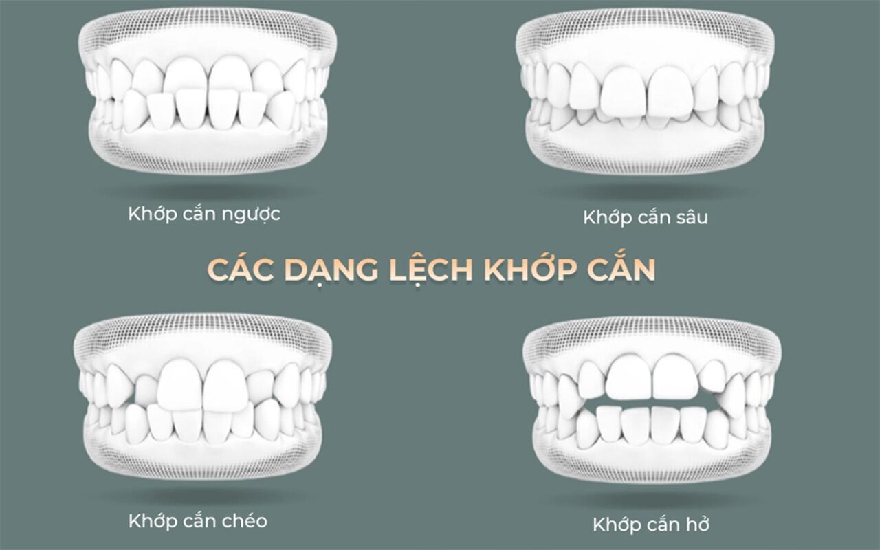Niềng chuẩn không chỉ để đẹp mà để Gen Z cười chill đúng chất 1 Niềng chuẩn không chỉ để đẹp mà để Gen Z cười chill đúng chất
