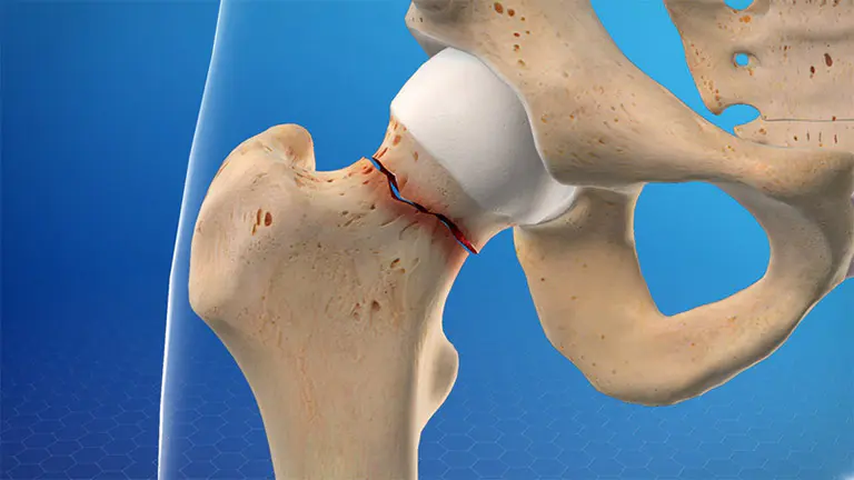 Phụ nữ mãn kinh khó tránh loãng xương: Nếu bạn không thuộc 3 nhóm sau thì xin chúc mừng! phu nu man kinh kho tranh loang xuong neu ban khong thuoc 3 nhom sau thi xin chuc mung